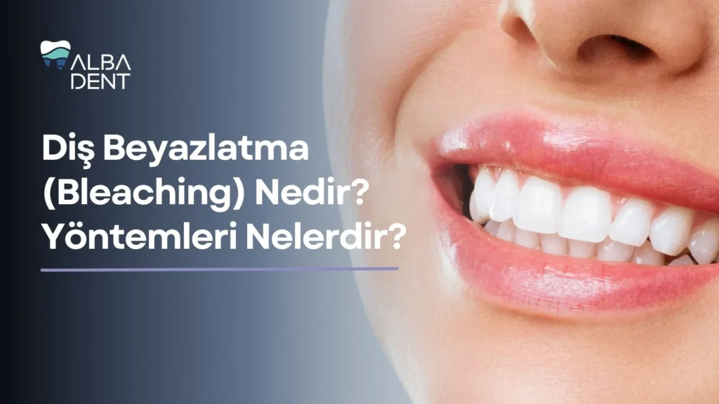 Diş Beyazlatma (Bleaching) Nedir? Yöntemleri Nelerdir?