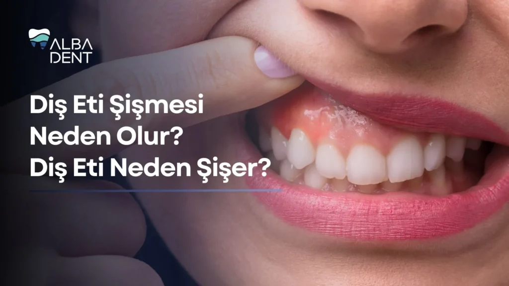 Diş Eti Şişmesi Neden Olur? Diş Eti Neden Şişer?