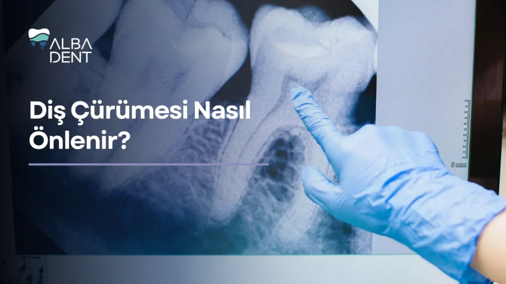 Diş Çürümesi Nasıl Önlenir?