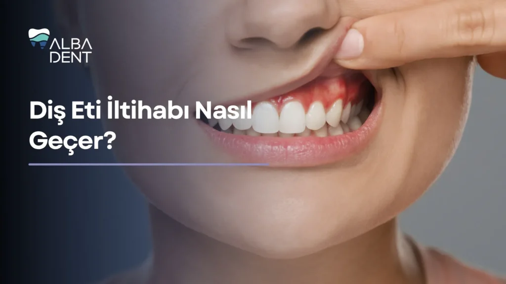 Diş Eti İltihabı Nasıl Geçer?