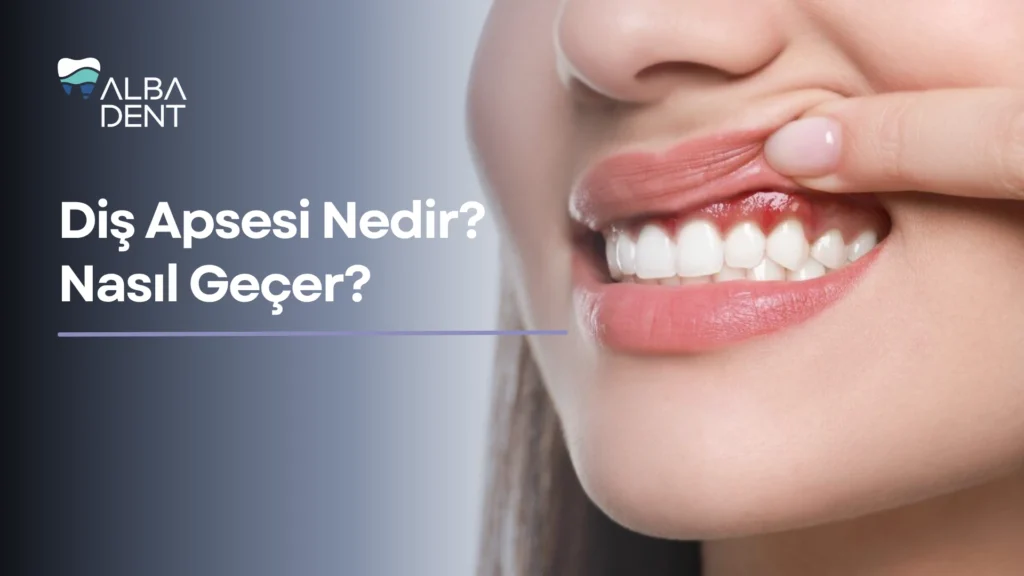 Diş Apsesi Nedir?