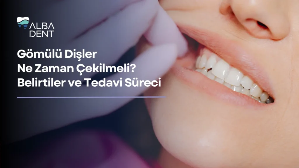 Gömülü Dişler Ne Zaman Çekilmeli?